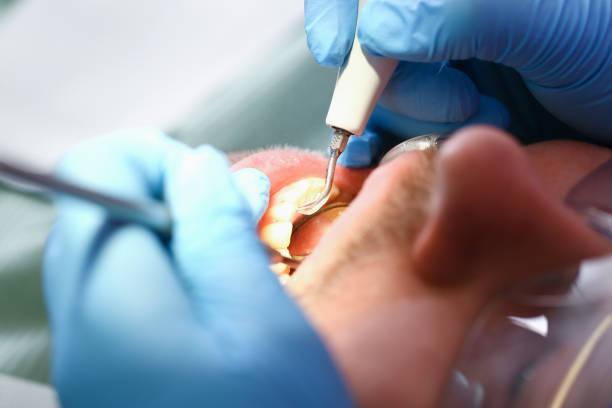 Best Chipped Tooth Repair Near Me  in La Cygne, KS