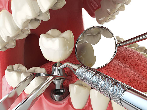 Best Root Canal Emergency Dentist  in La Cygne, KS